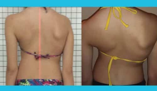 escoliose tratamento 5 meses