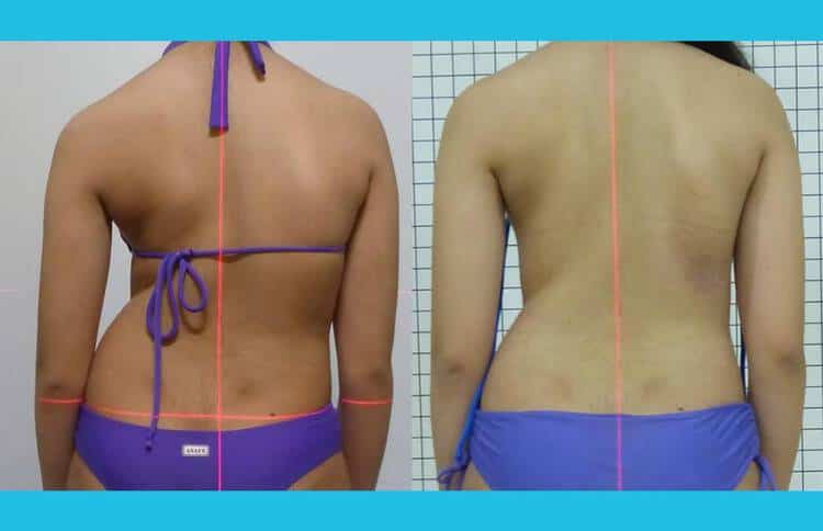 Acompanhamento de adolescente de 13 anos com escoliose acima de 50 graus Cobb em tratamento conservador