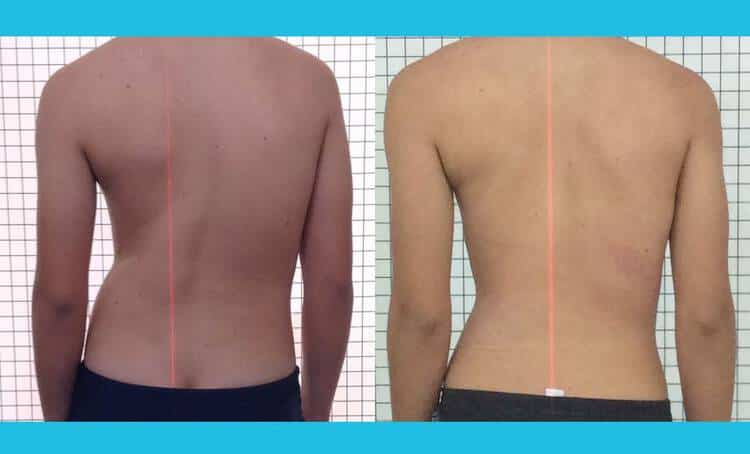 Acompanhamento de adolescente do sexo masculino com escoliose em tratamento conservador SEAS