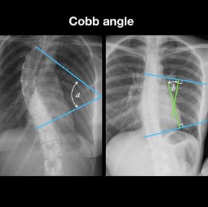 angulo de cobb 2 radiografia exemplificando Ângulo de cobb -