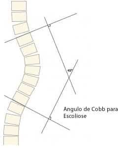 angulo de Cobb instituto de escoliose dra patricia italo mentges