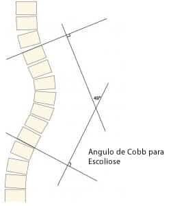 angulo de Cobb instituto de escoliose dra patricia italo mentges