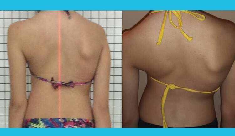 escoliose tratamento 5 meses
