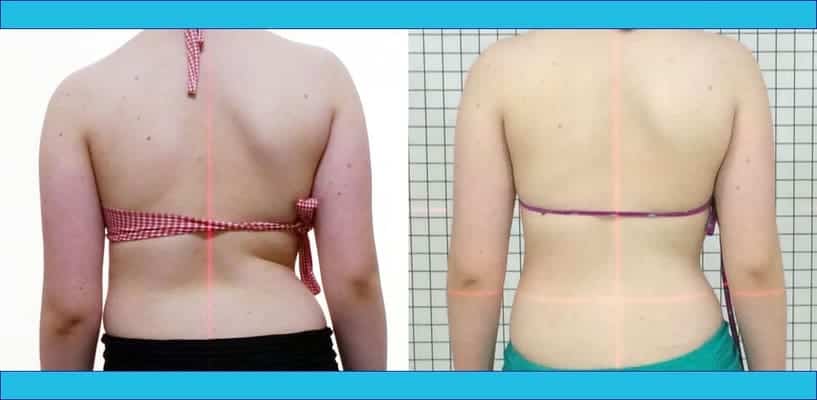 Acompanhamento de adolescente de 12 anos com escoliose em tratamento conservador SEAS